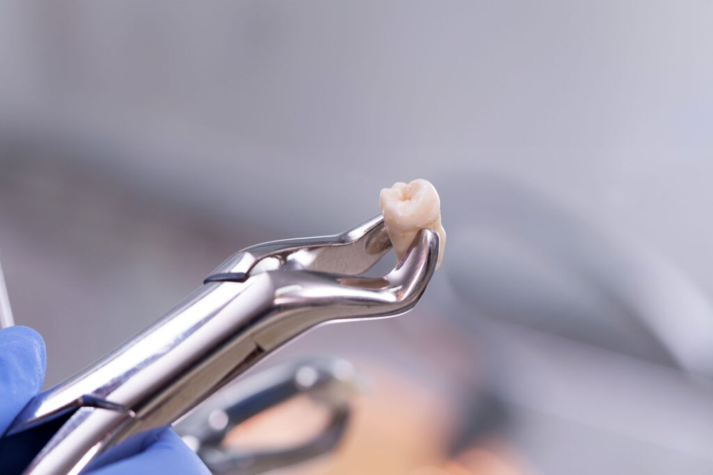 Close-up of a stainless steel dental extractor holding a removed molar tooth, with a blurred background emphasizing the detail of the tooth and the dental instrument.