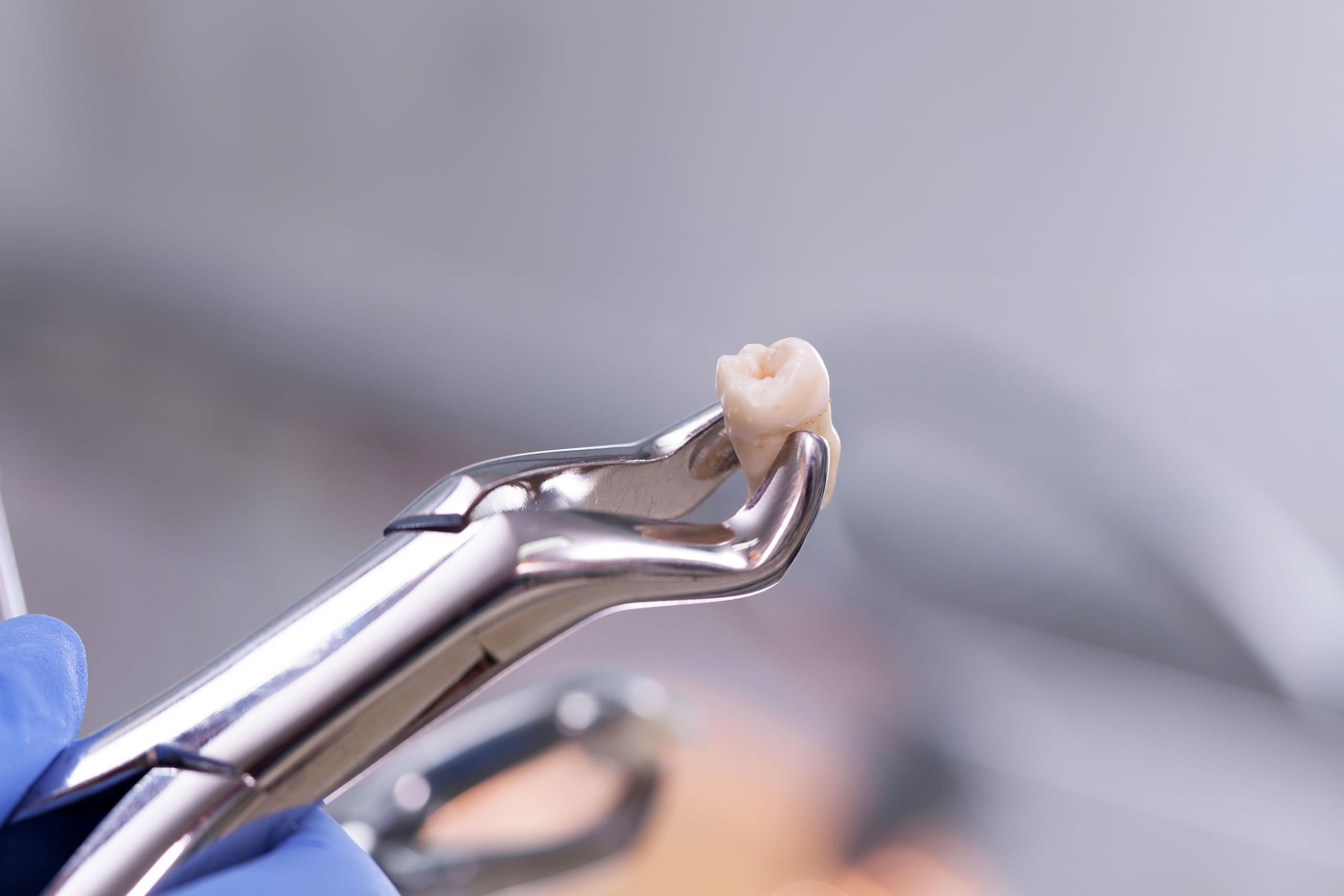 Close-up of a stainless steel dental extractor holding a removed molar tooth, with a blurred background emphasizing the detail of the tooth and the dental instrument.