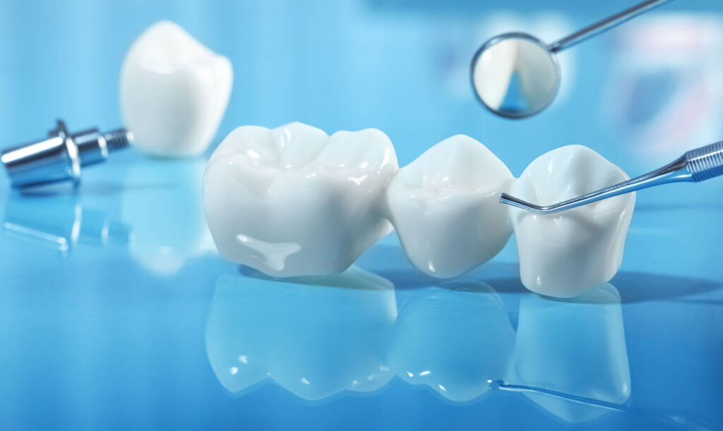 Dental bridge consisting of three ceramic crowns on a reflective blue surface with dental instruments nearby, including a mirror and a probe, in a bright dental office setting.