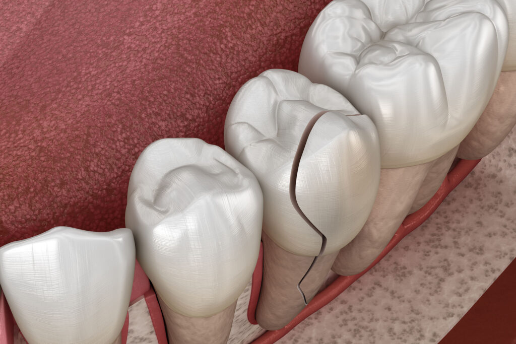Detailed 3D illustration showing the process of a cracked tooth, with a focus on the tooth's structure and the gum line.