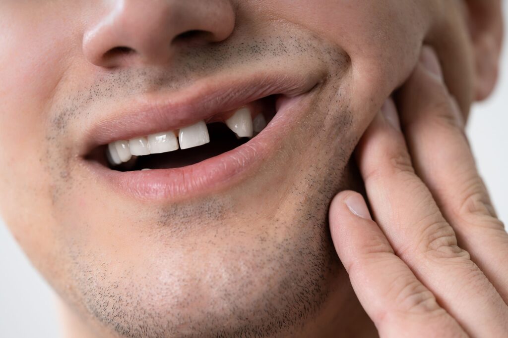 Close-up of a man's smile showing broken and missing teeth, with one hand on his cheek, highlighting the need for dental care, set against a white background.
