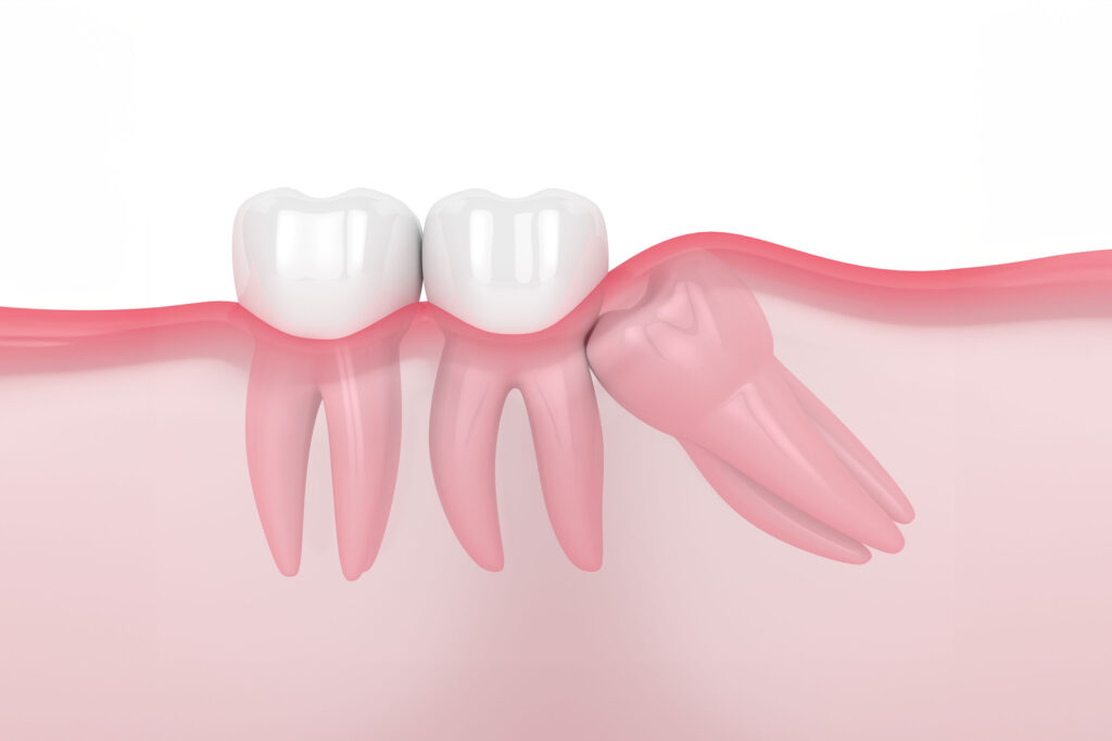 3D rendering of a row of healthy teeth, with one tooth depicting the discomfort of wisdom tooth pain, highlighted by red, inflamed gums surrounding the affected area, set against a gradient background transitioning from white to red to symbolize the intensity of the pain.