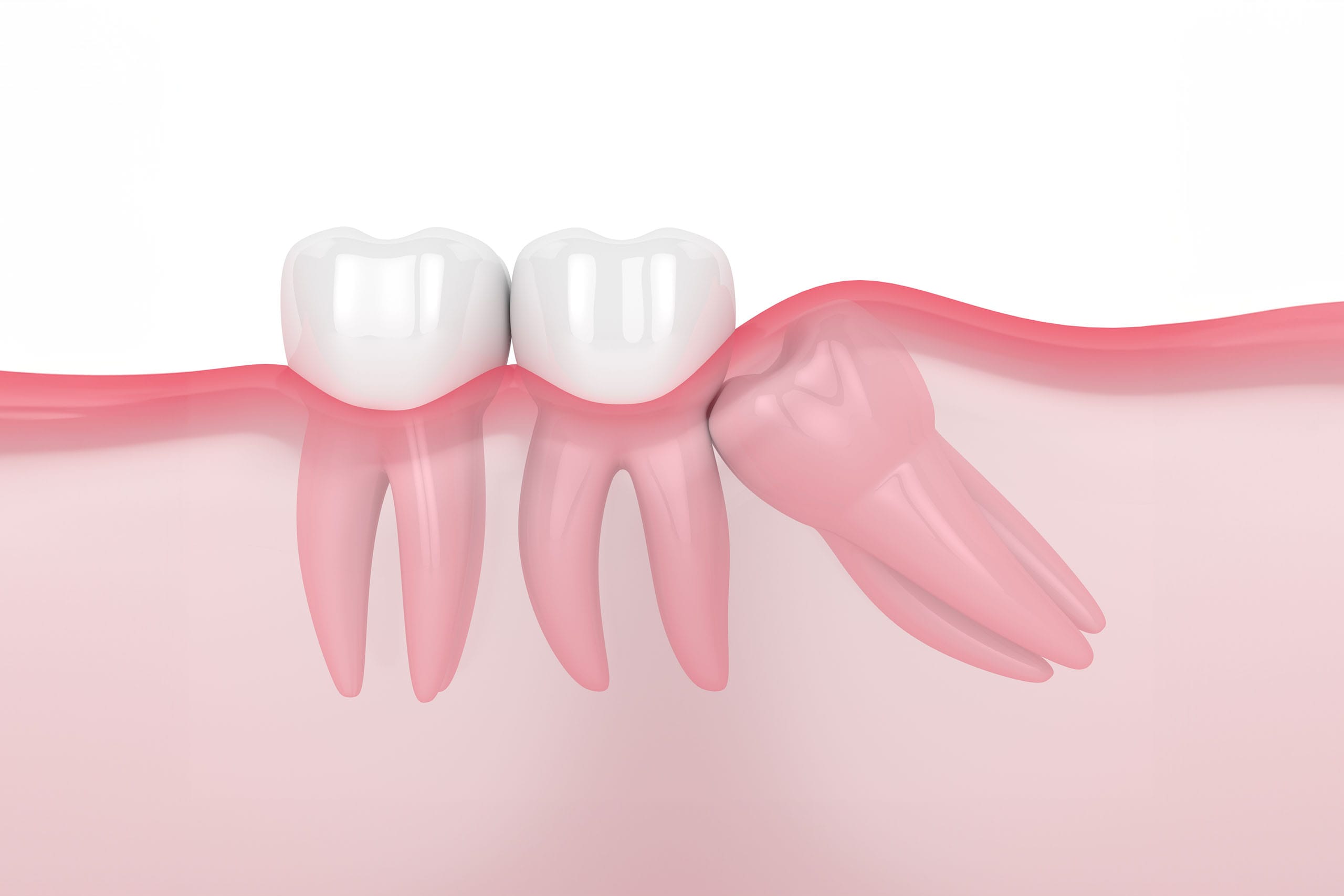 3D rendering of a row of healthy teeth, with one tooth depicting the discomfort of wisdom tooth pain, highlighted by red, inflamed gums surrounding the affected area, set against a gradient background transitioning from white to red to symbolize the intensity of the pain.