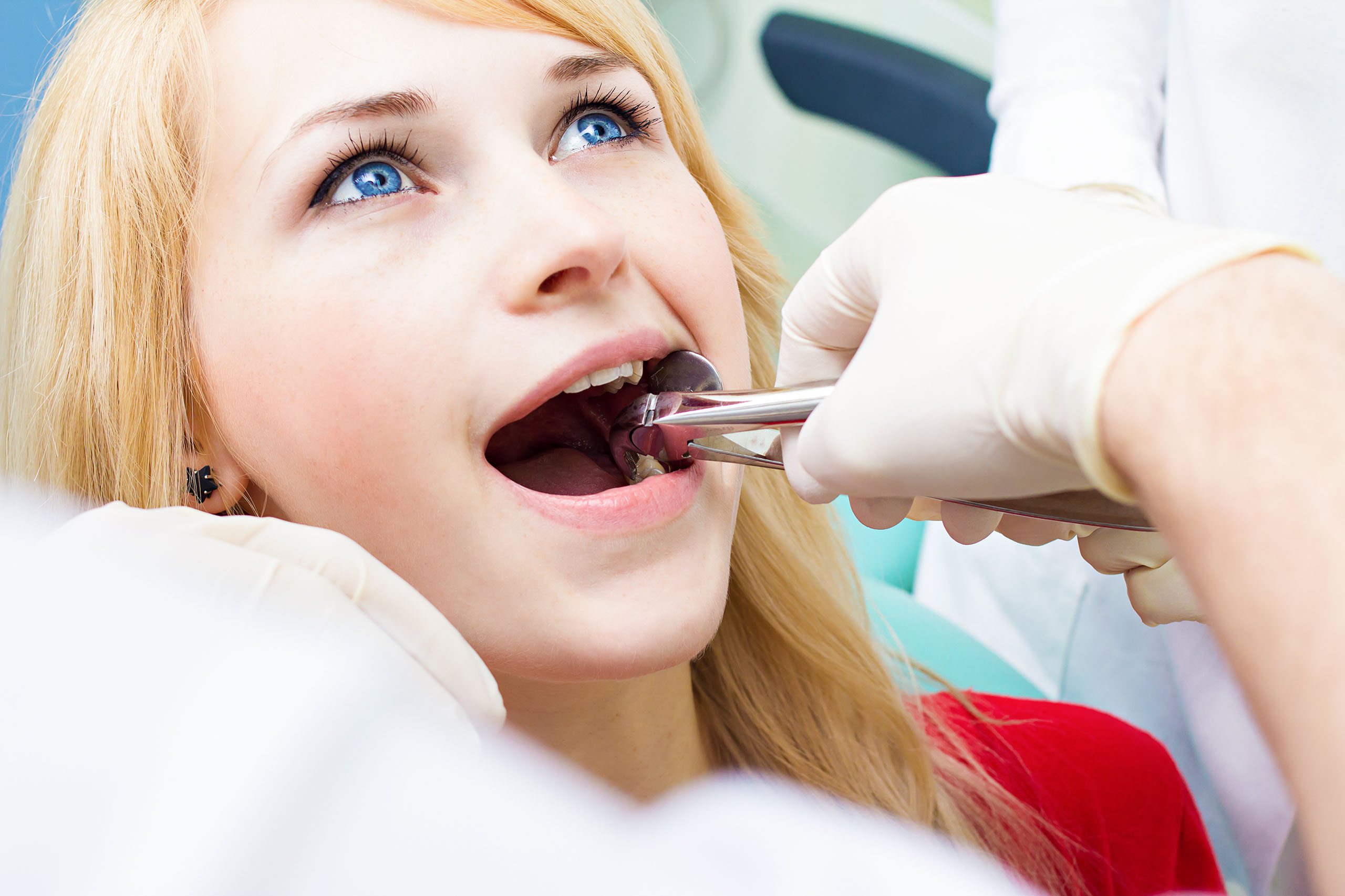 Close-up of a dental extraction as forceps grip a tooth inside a patient’s mouth during treatment.