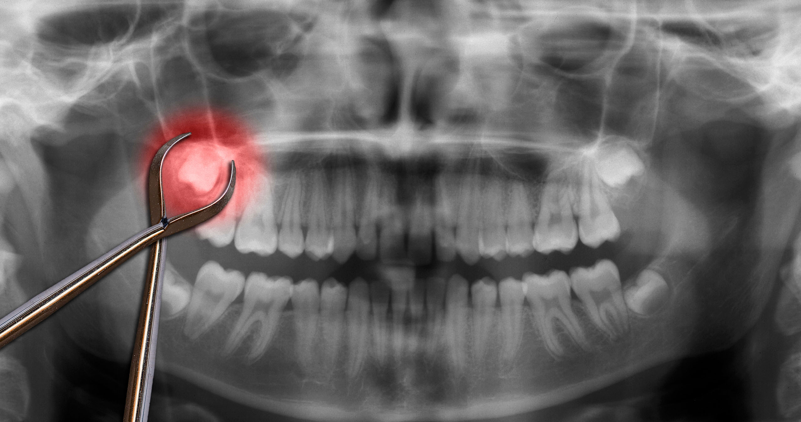 Dental panoramic X-ray showing a highlighted wisdom tooth and metal forceps positioned to indicate planned extraction.