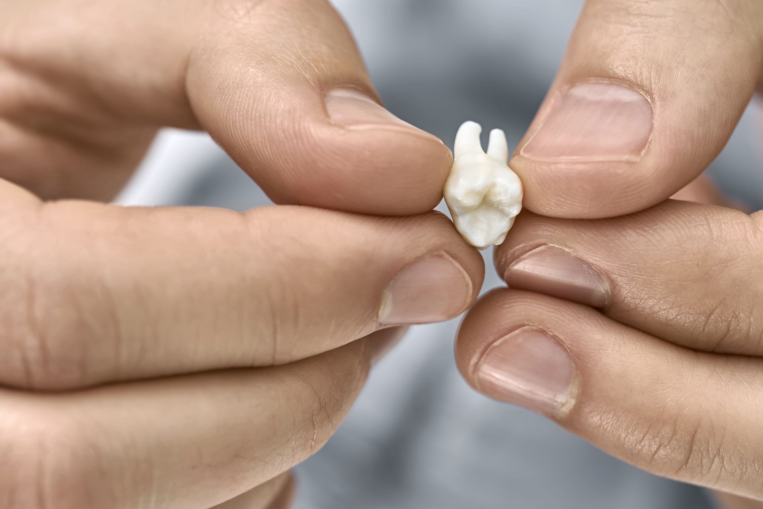 Close-up of hands holding an extracted human tooth, showing roots and crown after dental removal