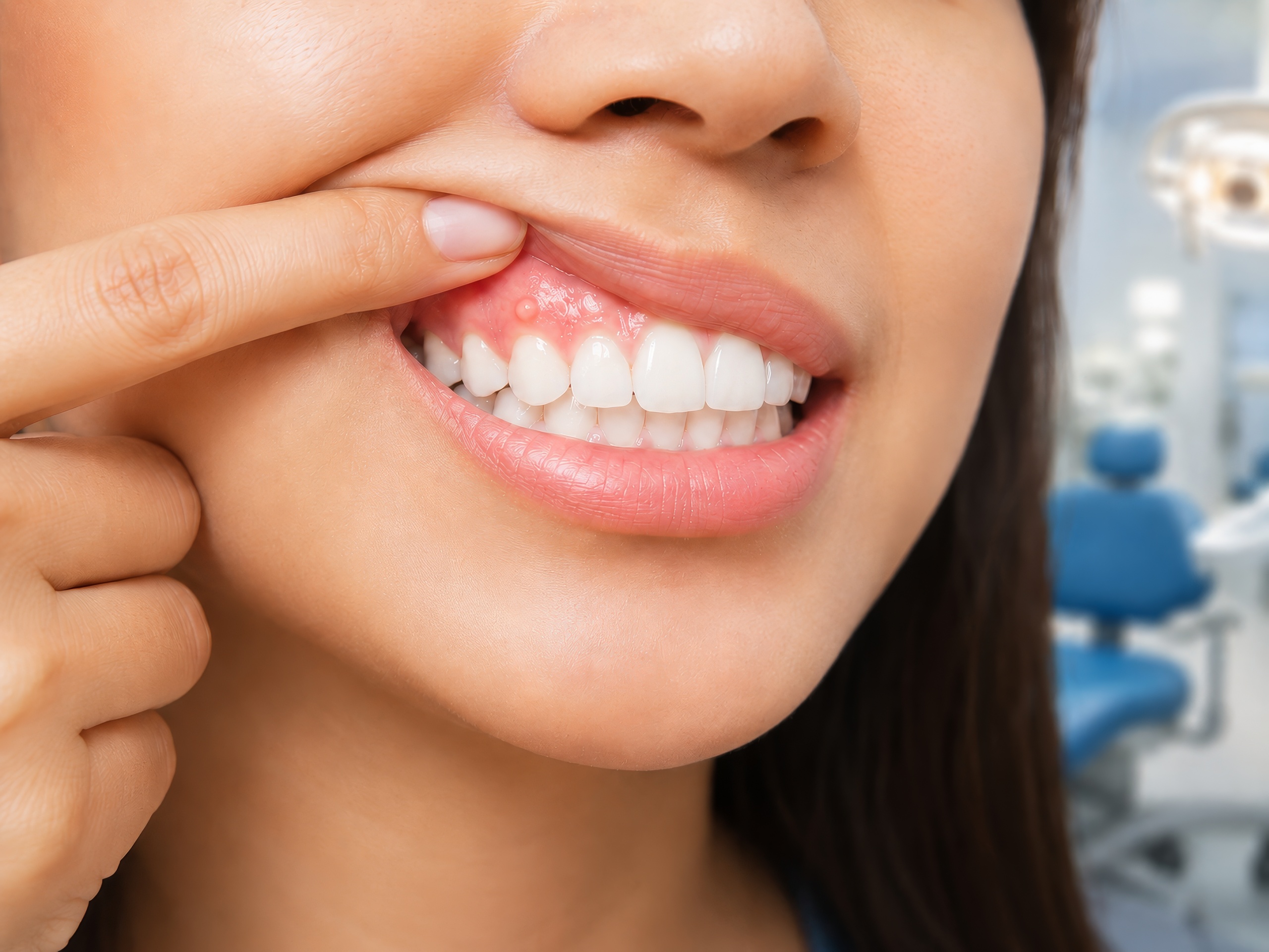 Dental Abscess Close-up of a woman lifting her upper lip to reveal a small, mildly inflamed dental abscess above a front tooth, with a blurred modern dental office in the background.